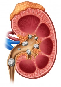 PCNL-kidney-stones